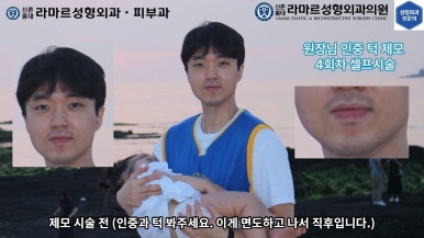 [성형외과 전문의의 셀프시술 제8편] 인중, 아래턱 제모 4회차 결과 공개! 관련 이미지 154