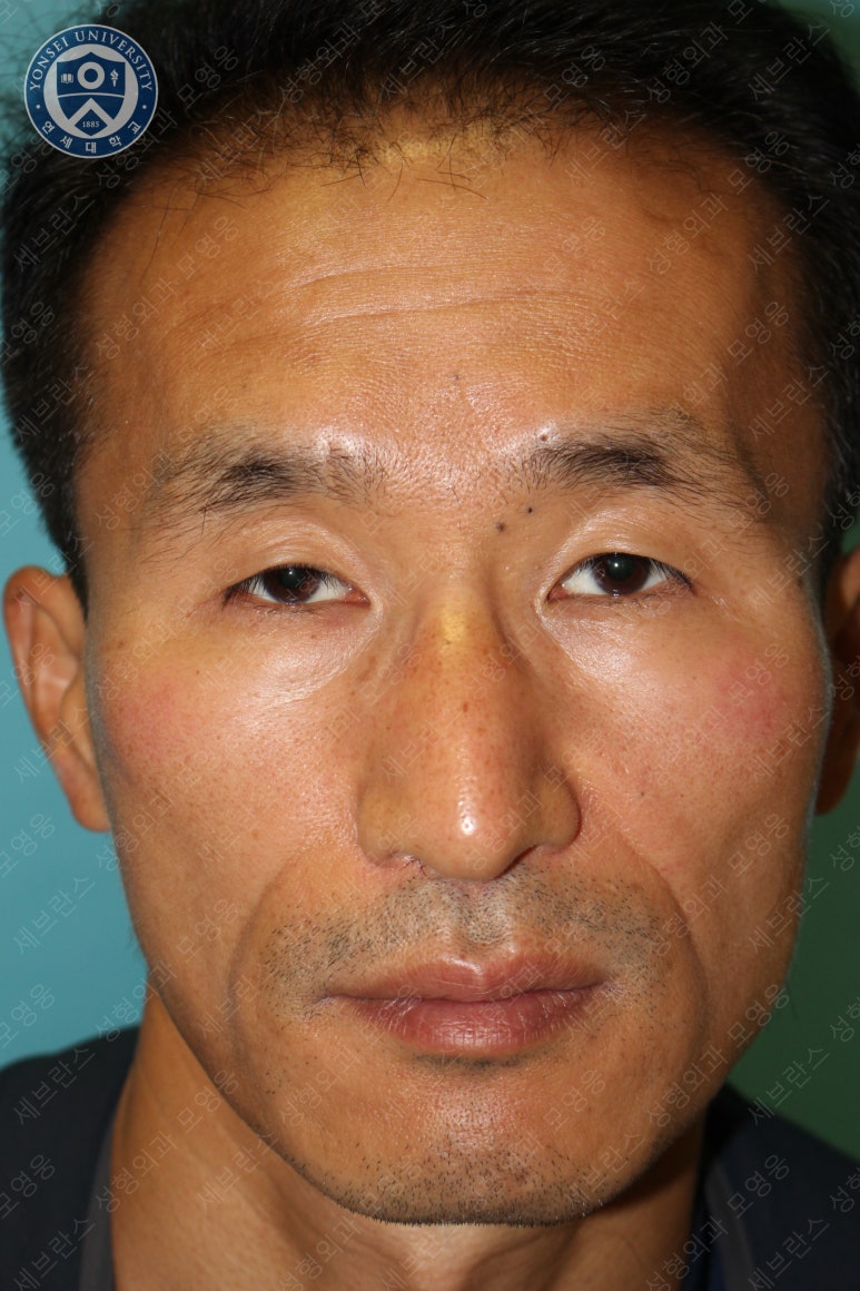 남자눈성형: 무쌍눈매교정 (Blephroptosis correction-levator aponeurosis advancement) 관련 이미지 10