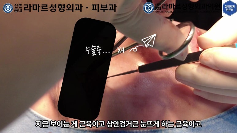 29세 남자, 소시지 쌍꺼풀 두줄따기로 낮추기 (쌍꺼풀 재수술) 관련 이미지 29