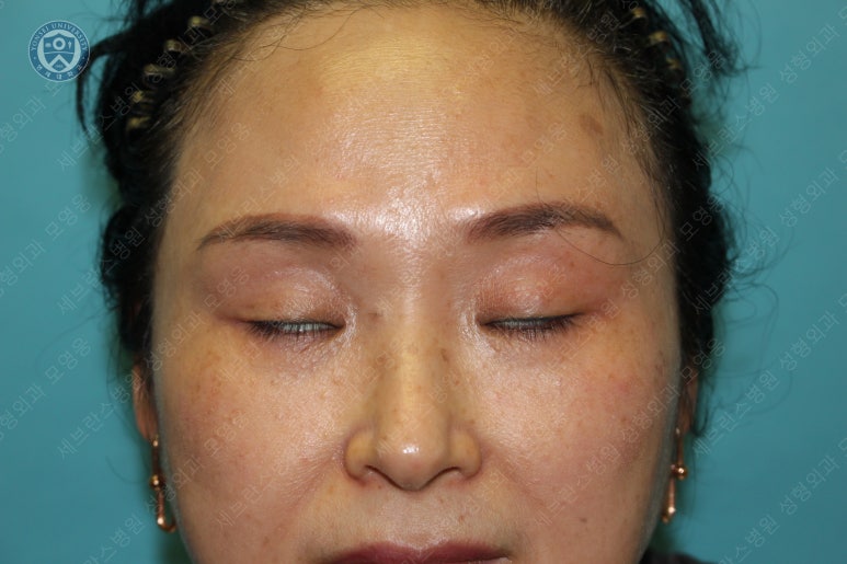49세 여성, 토안이 있는 중년여성의 상안검성형술 (49/F, Upper blepharoplasty with lagophthalmos correction& LP) 관련 이미지 4