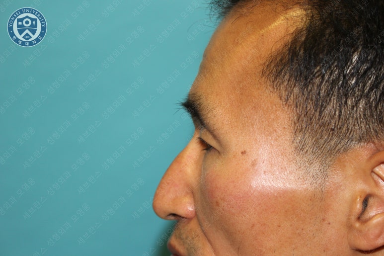 남자눈성형: 무쌍눈매교정 (Blephroptosis correction-levator aponeurosis advancement) 관련 이미지 16