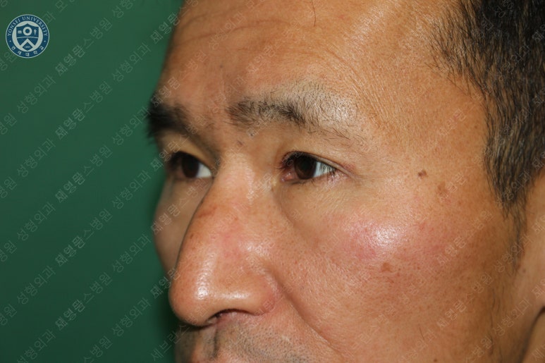 남자눈성형: 무쌍눈매교정 (Blephroptosis correction-levator aponeurosis advancement) 관련 이미지 34