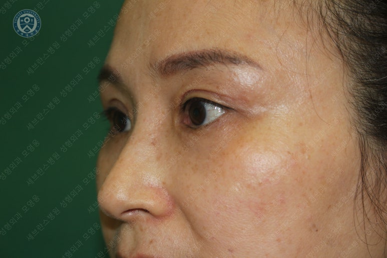 49세 여성, 토안이 있는 중년여성의 상안검성형술 (49/F, Upper blepharoplasty with lagophthalmos correction& LP) 관련 이미지 28