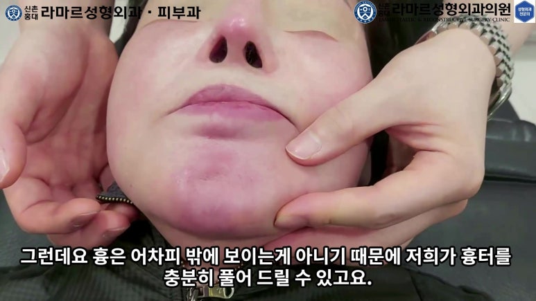 파라핀 필러 입 안 절개로 흉터없이 빼내기! 관련 이미지 106
