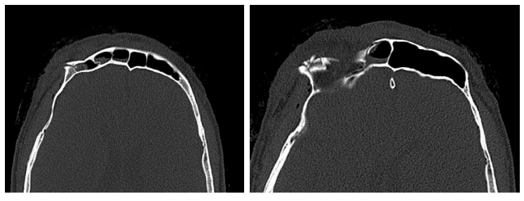 57세 남성, 얼굴 전체골절(57/M Panfacial bone fracture) 수술 및 흉터관리 증례 관련 이미지 3