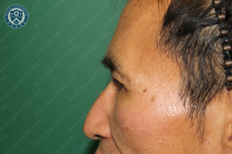 남자눈성형: 무쌍눈매교정 (Blephroptosis correction-levator aponeurosis advancement) 관련 이미지 25