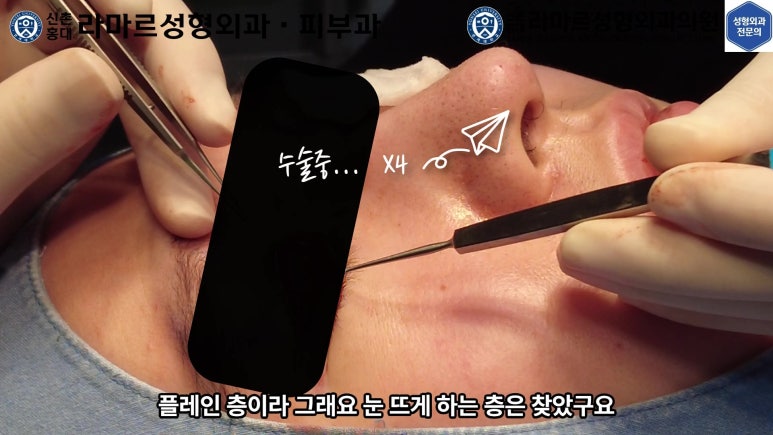 29세 남자, 소시지 쌍꺼풀 두줄따기로 낮추기 (쌍꺼풀 재수술) 관련 이미지 28