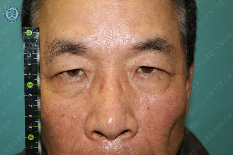 67세 남성, 상&middot;하안검성형술 및 안검하수교정 (67/M, Upper &  lower blepharoplasty with ptosis correction) 관련 이미지 11