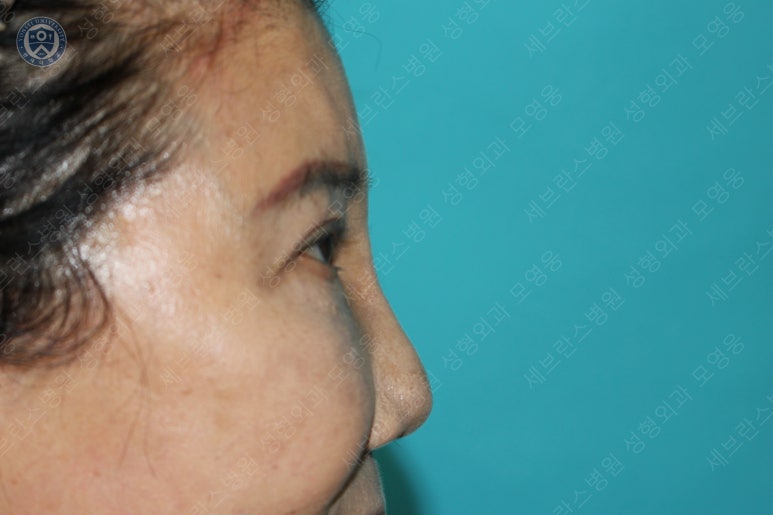 71세 여성, 이마거상술과 이마축소술 (71/F, Forehead lift and reduction) 관련 이미지 47