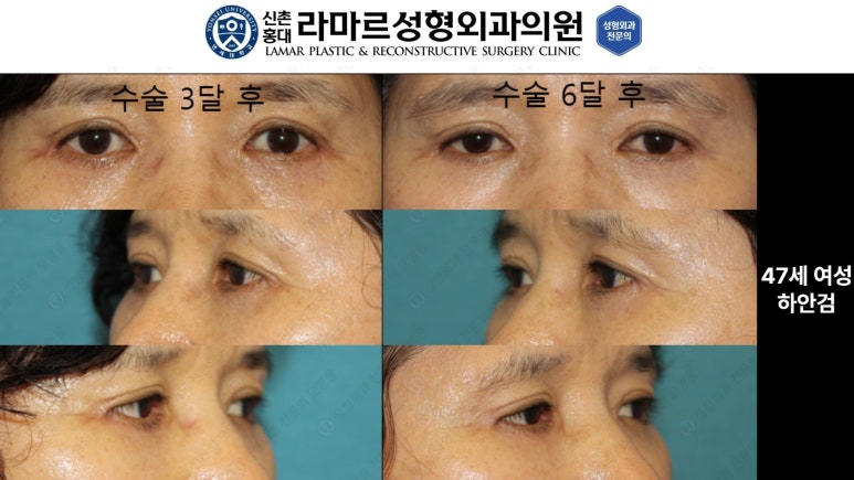30대~80대 눈 수술 케이스 : 하안검성형술 전후 사진 모음 관련 이미지 17