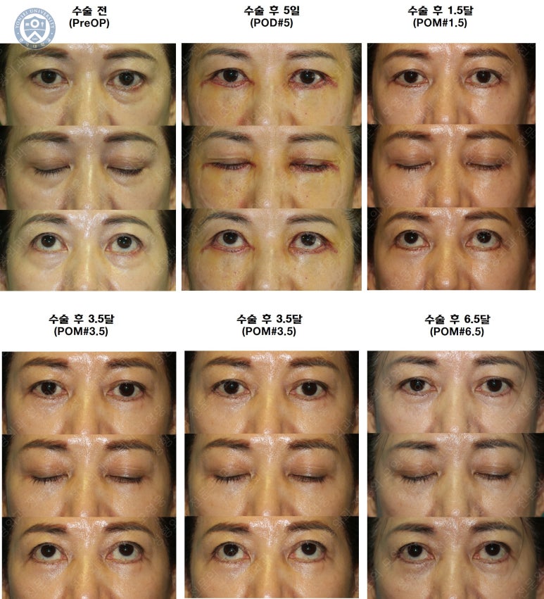 59세 여성, 그레이브스 안병증이 있는 돌출눈 중년 여성 하안검 성형술 (Lower blepharoplasty in Graves 관련 이미지 44