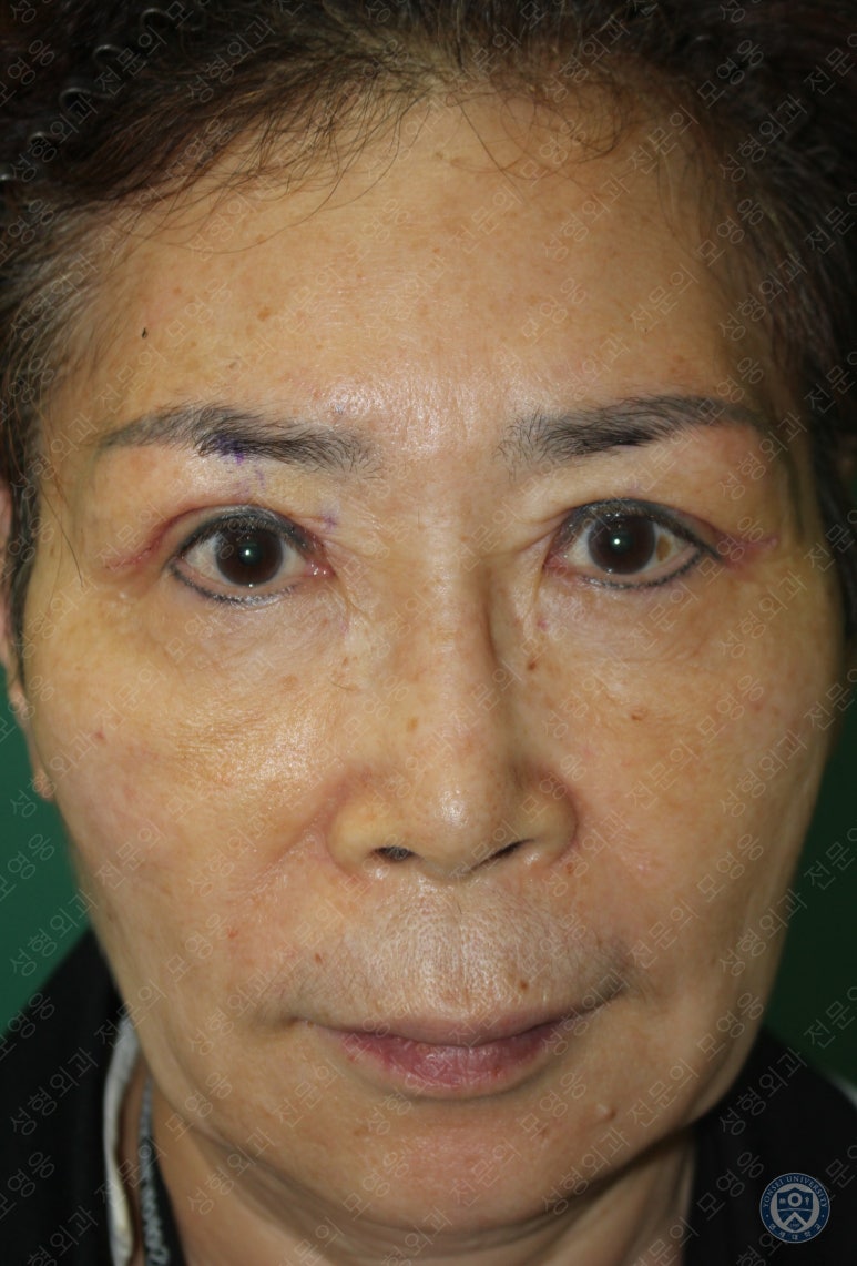 64세 여성 상안검성형술+눈매교정 (64/F Upper blepharoplasty with ptosis correction) 관련 이미지 10