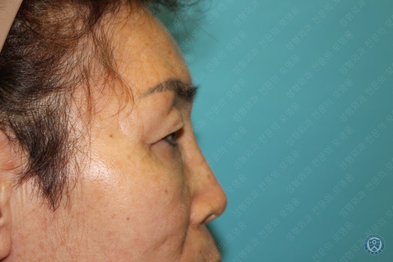64세 여성 상안검성형술+눈매교정 (64/F Upper blepharoplasty with ptosis correction) 관련 이미지 9