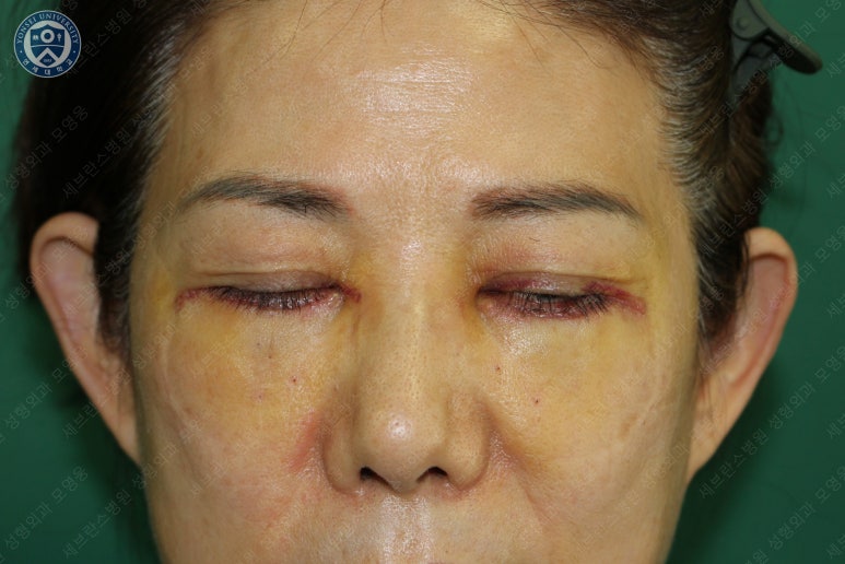 59세 여성, 그레이브스 안병증이 있는 돌출눈 중년 여성 하안검 성형술 (Lower blepharoplasty in Graves 관련 이미지 11