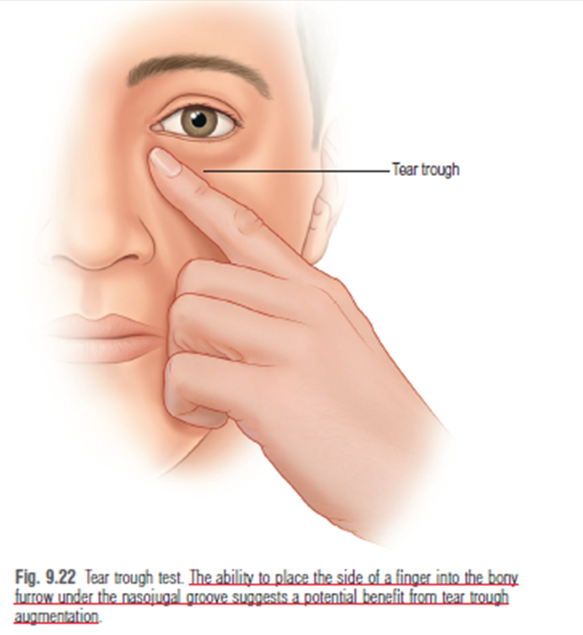 28세 여성, 눈밑지방재배치(눈밑지, 28/F Transconjunctival septal fat redraping-internal fixation technique) 관련 이미지 11