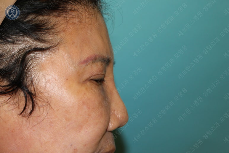 71세 여성, 이마거상술과 이마축소술 (71/F, Forehead lift and reduction) 관련 이미지 9