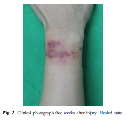JKBS-Deep Second Degree Burn of Ferrous Chloride in a Worker at a Wastewater Treatment Facility 관련 이미지 5