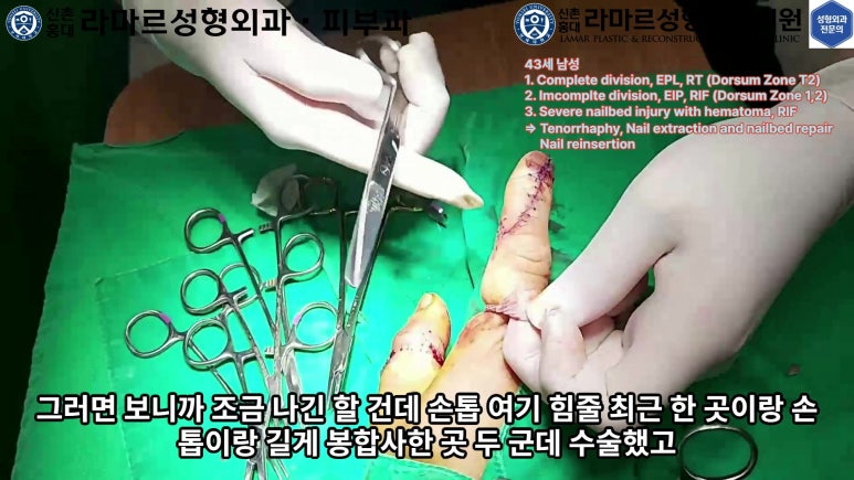 손가락 힘줄 손상 및 열상, 손톱 바닥 열상 처치 (Extensor tendon repair and nailbed injury treatment) 관련 이미지 32