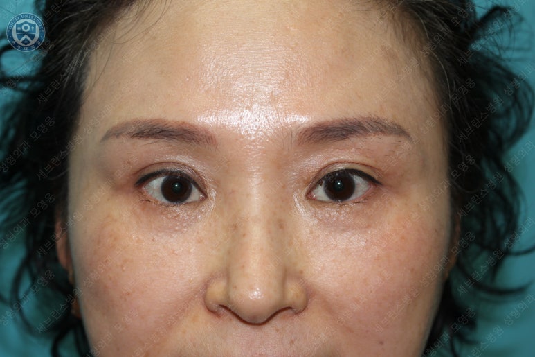 49세 여성, 토안이 있는 중년여성의 상안검성형술 (49/F, Upper blepharoplasty with lagophthalmos correction& LP) 관련 이미지 33
