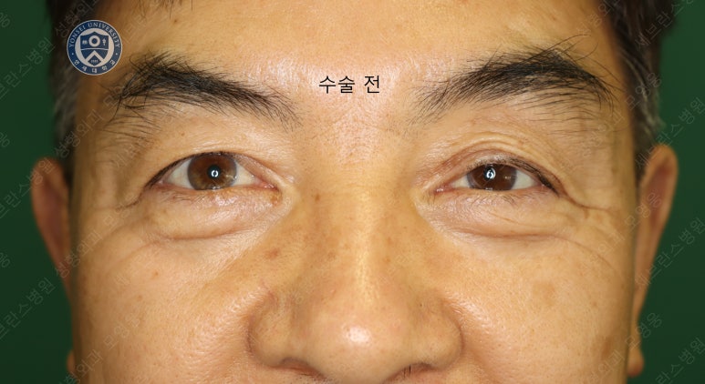68세 남성, 하안검 성형술 및 안검외반 교정 증례(68/M Lower blepharoplasty & Ectropion correction with triamcinolone) 관련 이미지 2