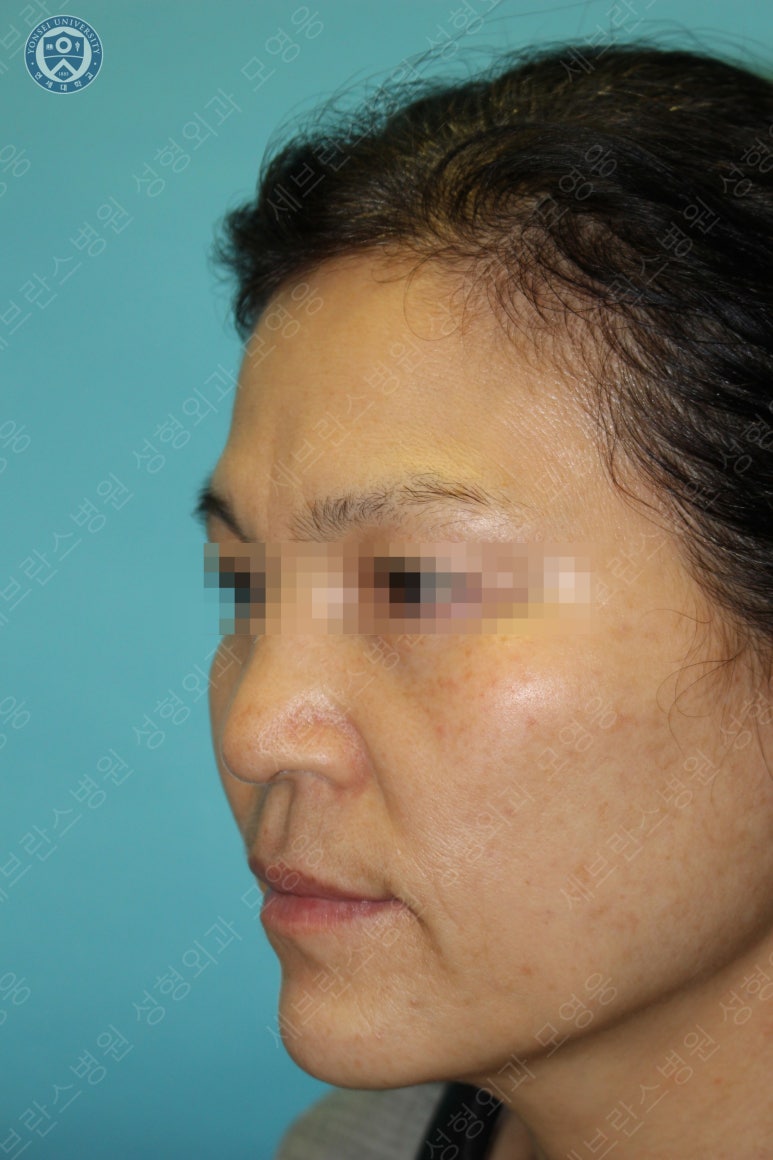 55세 여성, 이중평면 안면거상(55/F, Dual-plane full facelift) 관련 이미지 8