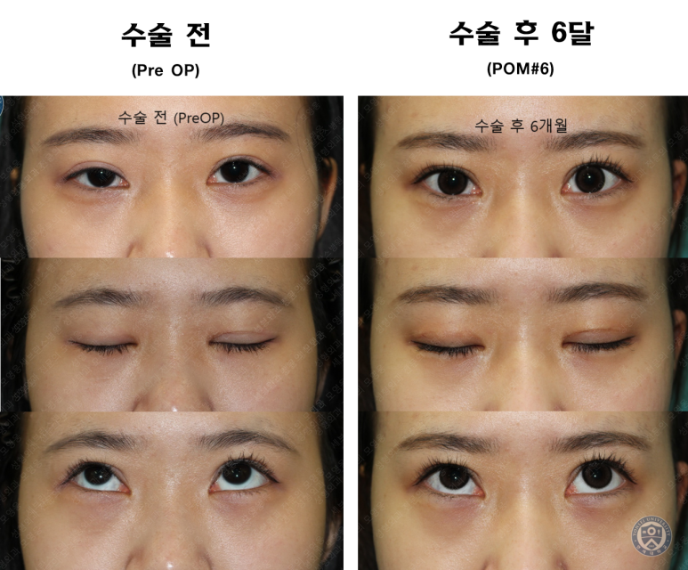17세 여성, 비절개 눈매교정 및 앞트임 재수술 (17/F NI ptosis correction & Med. epicanthoplasty revision) 증례 관련 이미지 18