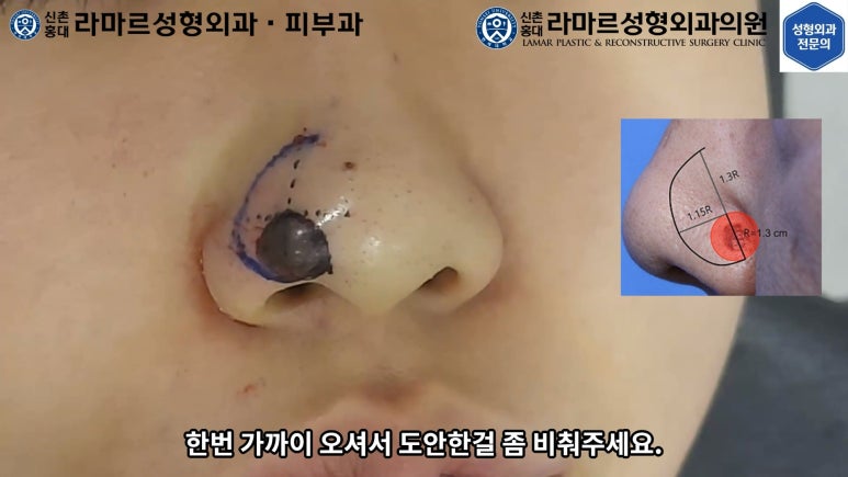 지름 1cm 코 점 제거수술 : 나선피판술(Spiral Flap) 수술전~1달 경과. (Feat. 턱끝필러+사각턱 보톡스) 관련 이미지 51