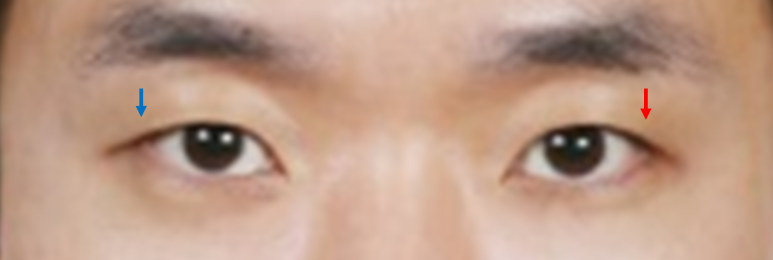 남자눈성형: 무쌍눈매교정 (Blephroptosis correction-levator aponeurosis advancement) 관련 이미지 7
