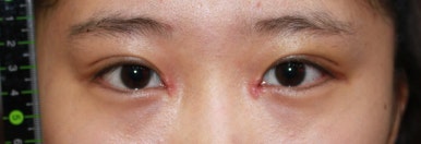 17세 여성, 쌍꺼풀+앞트임(DEO+Medial epicanthoplasty) 관련 이미지 17