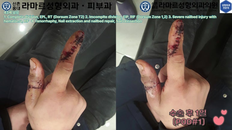손가락 힘줄 손상 및 열상, 손톱 바닥 열상 처치 (Extensor tendon repair and nailbed injury treatment) 관련 이미지 37