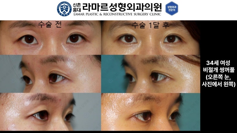 10대~30대 눈 수술 케이스 : 대표원장님 쌍꺼풀 전후 사진 모음 관련 이미지 16