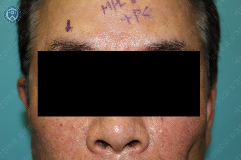 67세 남성, 상&middot;하안검성형술 및 안검하수교정 (67/M, Upper &  lower blepharoplasty with ptosis correction) 관련 이미지 18