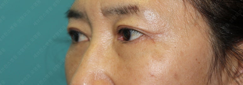 55세 여성, 상안검 및 하안검 성형술 증례 (55/F Upper & lower blepharoplasty) 관련 이미지 24