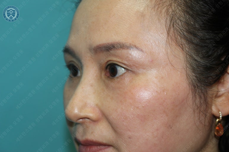 49세 여성, 토안이 있는 중년여성의 상안검성형술 (49/F, Upper blepharoplasty with lagophthalmos correction& LP) 관련 이미지 38