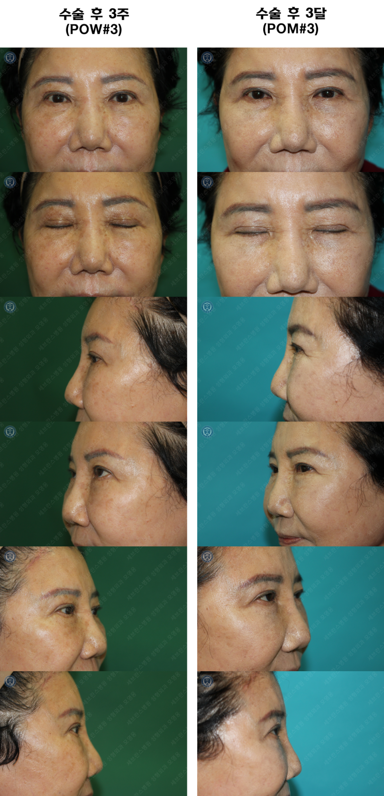 71세 여성, 이마거상술과 이마축소술 (71/F, Forehead lift and reduction) 관련 이미지 56