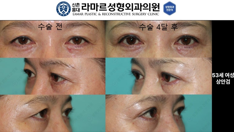 40대~80대 눈 수술 케이스 : 상안검성형술 전후 사진 모음 관련 이미지 22