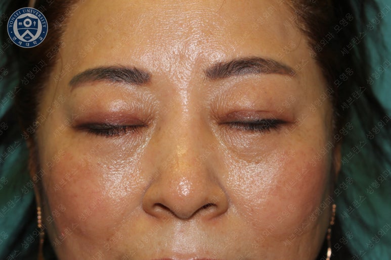 60세 여성, 상안검 및 하안검 성형술 증례 (60/F Upper & lower blepharoplasty) 관련 이미지 24