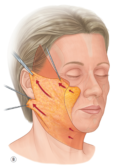 55세 여성, 이중평면 안면거상(55/F, Dual-plane full facelift) 관련 이미지 4