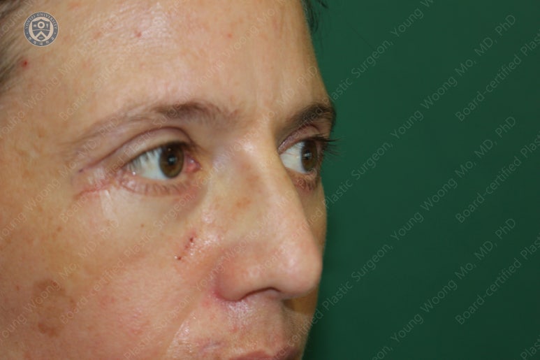 38세 서양 백인 여성, 쌍꺼풀 수술과 눈매교정 및 하안검성형술 (38/F Upper&lower blepharoplasty with levator plication) 관련 이미지 27