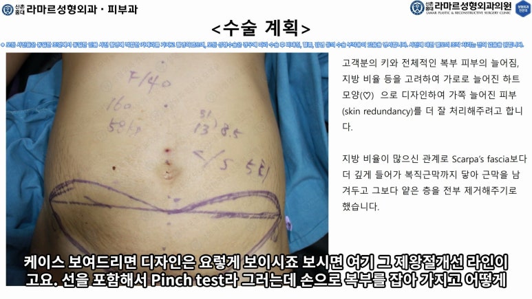 '복부성형술+지방흡입(Abdominoplasty+PAL)' 으로 뱃살 끝장내기! 관련 이미지 33