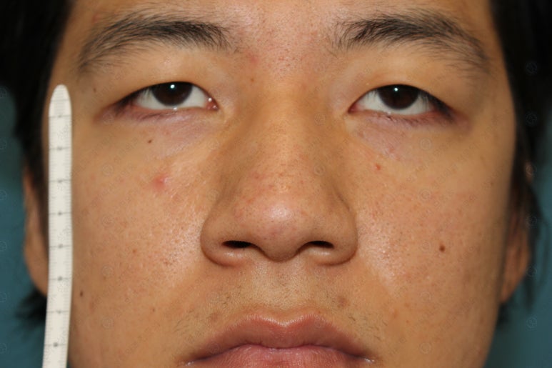 27세 남성 무쌍(속쌍)눈매교정 (27/M Ptosis correction with double lid plasty) 관련 이미지 8