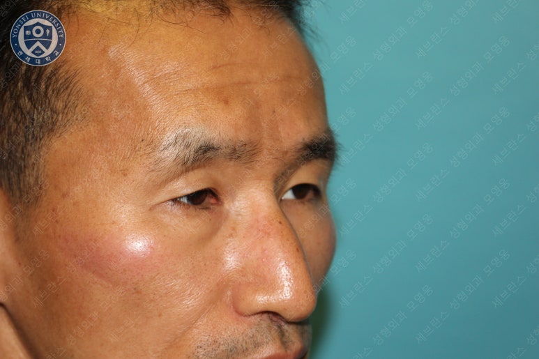 남자눈성형: 무쌍눈매교정 (Blephroptosis correction-levator aponeurosis advancement) 관련 이미지 14