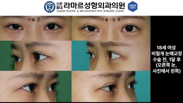 10대~30대 눈 수술 케이스 : 대표원장님 쌍꺼풀 전후 사진 모음 관련 이미지 7