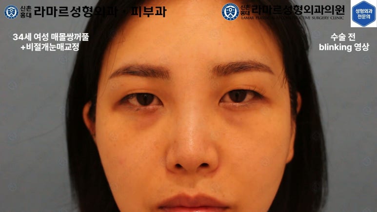 30대 여성 "쌍꺼풀+눈매교정" 상담, 디자인, 수술 전체 과정, 결과, 경과 모두 공개합니다. 관련 이미지 44