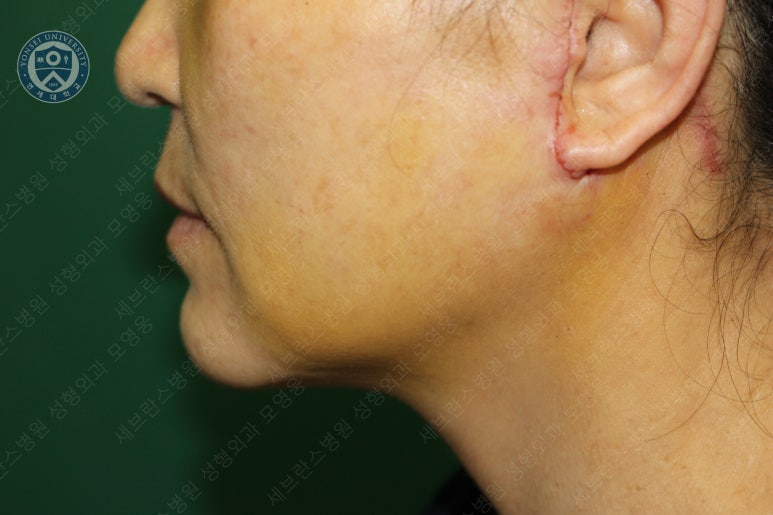 55세 여성, 이중평면 안면거상(55/F, Dual-plane full facelift) 관련 이미지 32