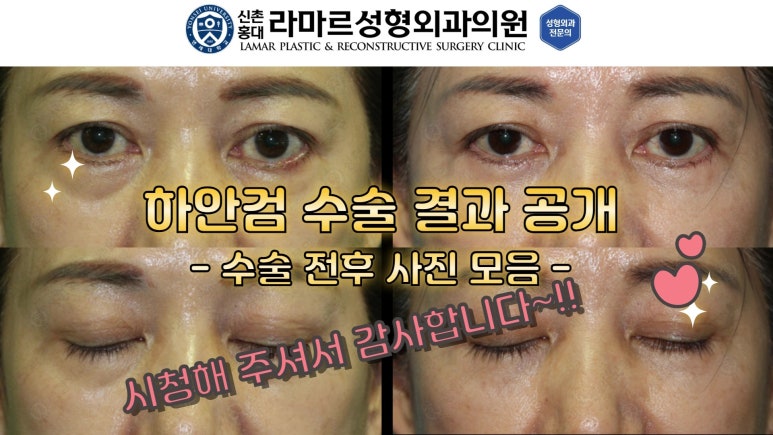 30대~80대 눈 수술 케이스 : 하안검성형술 전후 사진 모음 관련 이미지 60