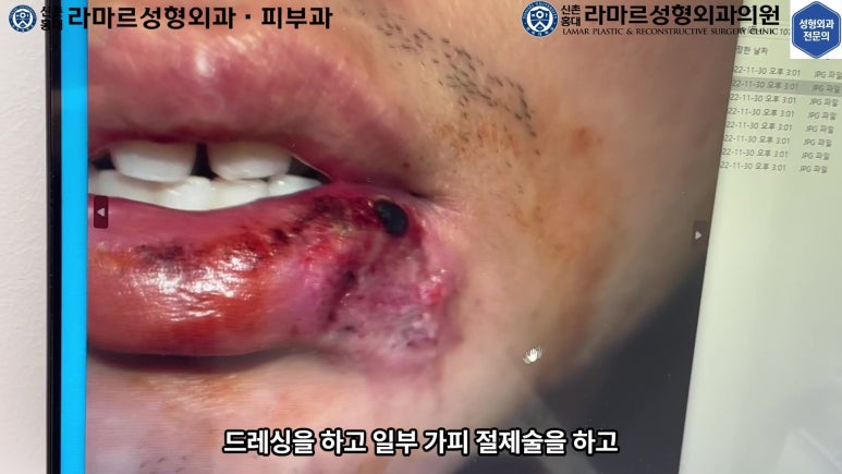 개에 물려 입술 1/3이 뜯긴 19세 남자분 치료 및 흉터 성형수술& 레이저 후기....! 관련 이미지 21
