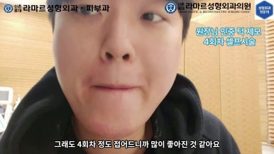 [성형외과 전문의의 셀프시술 제8편] 인중, 아래턱 제모 4회차 결과 공개! 관련 이미지 139