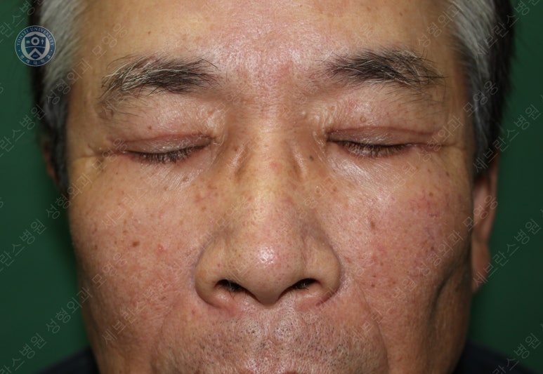67세 남성, 상&middot;하안검성형술 및 안검하수교정 (67/M, Upper &  lower blepharoplasty with ptosis correction) 관련 이미지 30