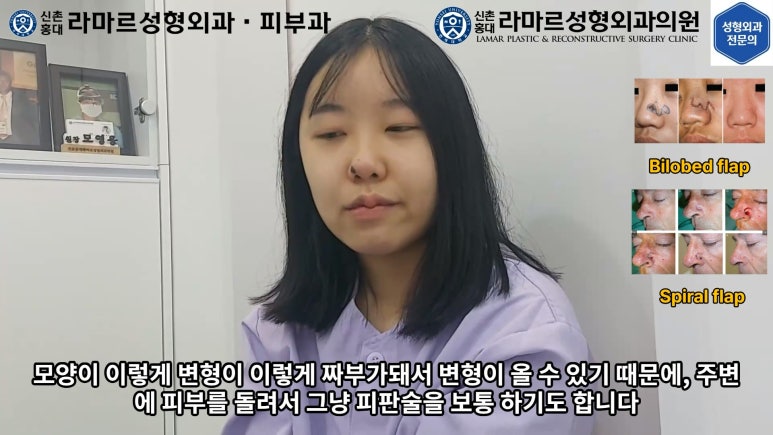 지름 1cm 코 점 제거수술 : 나선피판술(Spiral Flap) 수술전~1달 경과. (Feat. 턱끝필러+사각턱 보톡스) 관련 이미지 29